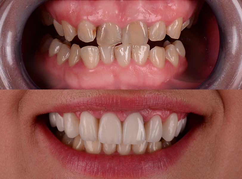 Metamorfoza 6 – Licówki Individual